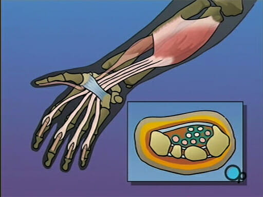 Carpal Tunnel Syndrome Repair Surgery • 
