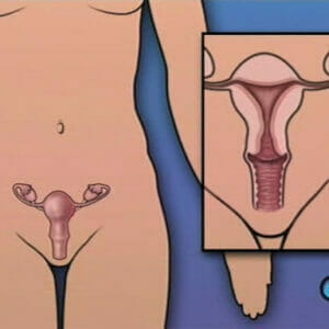 Hysterectomy Removal of the Uterus • 