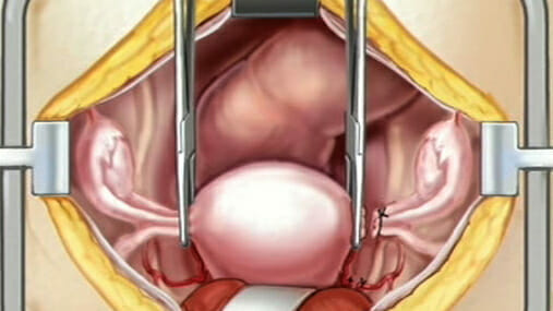 Hysterectomy Removal of the Uterus • 