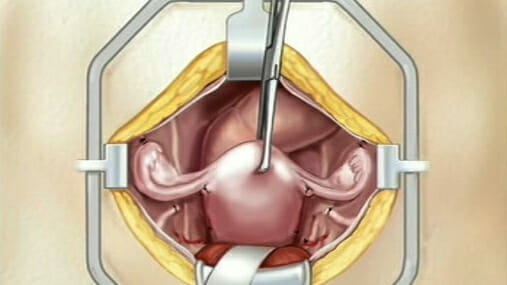 Hysterectomy Removal of Uterus, Ovaries and Fallopian Tubes Surgery •  